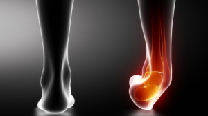 O que fazer para se recuperar rapidamente de torções no tornozelo