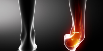 O que fazer para se recuperar rapidamente de torções no tornozelo